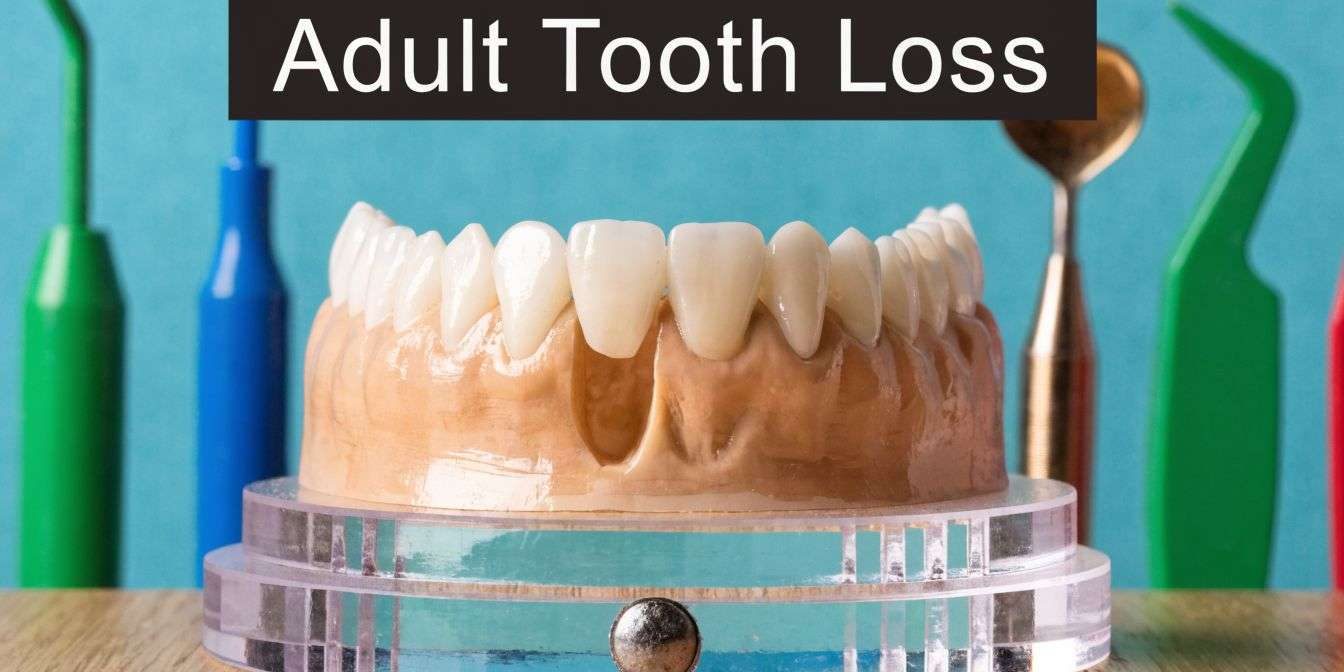 at-what-age-do-adults-start-losing-teeth-tooth-loss Dental model showing upper teeth on a stand with a banner reading 'Adult Tooth Loss'.